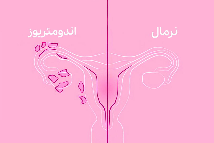 g/تشخیص اندومتریوز با آزمایش خون