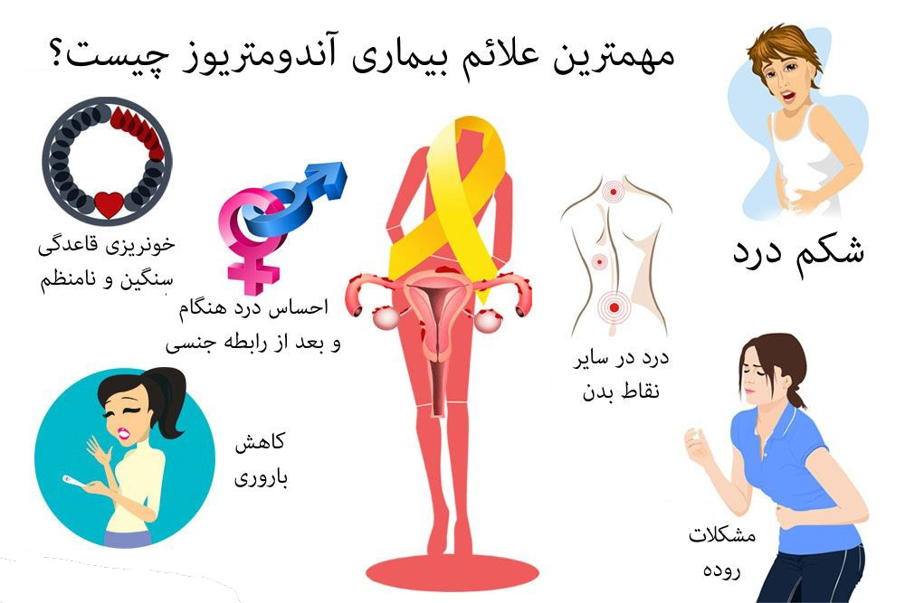 f/علائم اندومتریوز