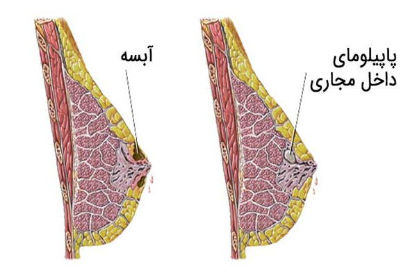 k/عفونت پستان