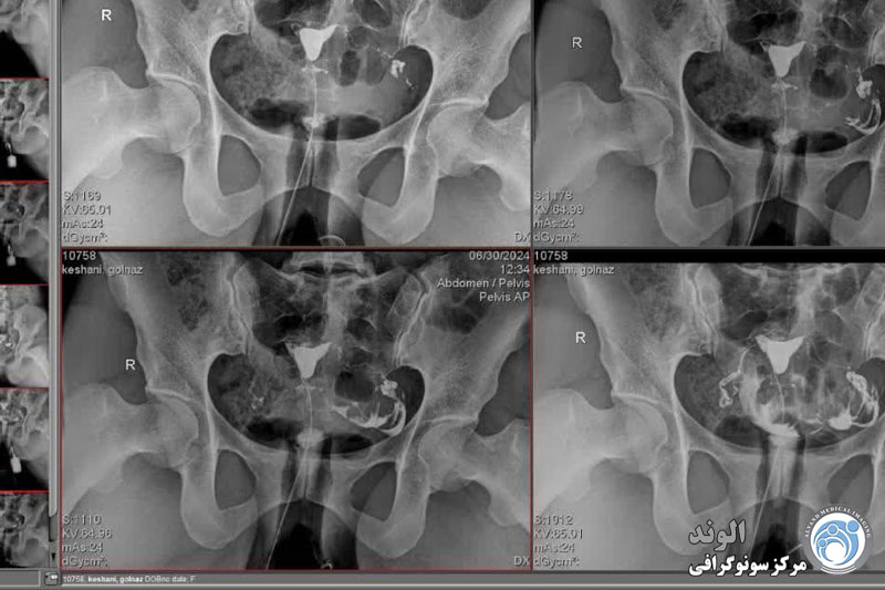 d/هیستروسالپنگوگرافی هیستروسالپنگوگرافی