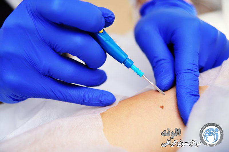 بیوپسی  از کلیه نقاط بدن |مراقبت های بعد از بیوپسی کلیه |بیوپسی کلیه