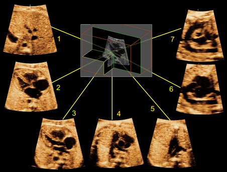 Echocardiography/اکوی قلب جنین در دوران بارداری