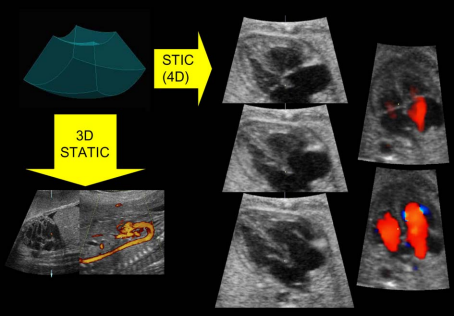 Echocardiography/اکوی قلب جنین در دوران بارداری