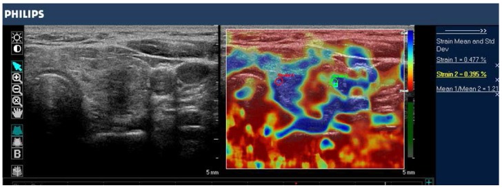 elastography/الاستوگرافی