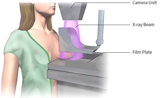 mammogram/ماموگرافی چیست و چطور انجام می شود؟