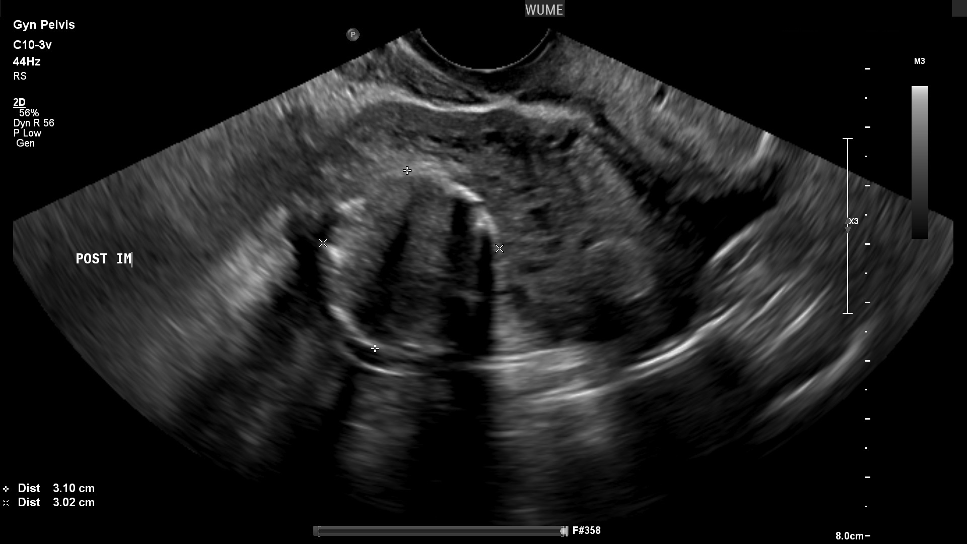 The best time for a vaginal ultrasound/بهترین زمان برای سونوگرافی واژینال